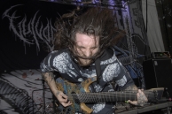 VULVODYNIA